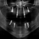 X-ray of All-on-4 Dental Implants