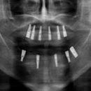 X-ray of All-on-6 Dental Implants
